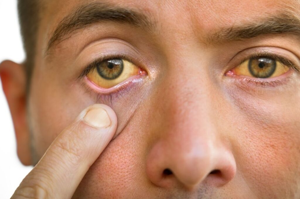 man with yellow eyes from liver disease